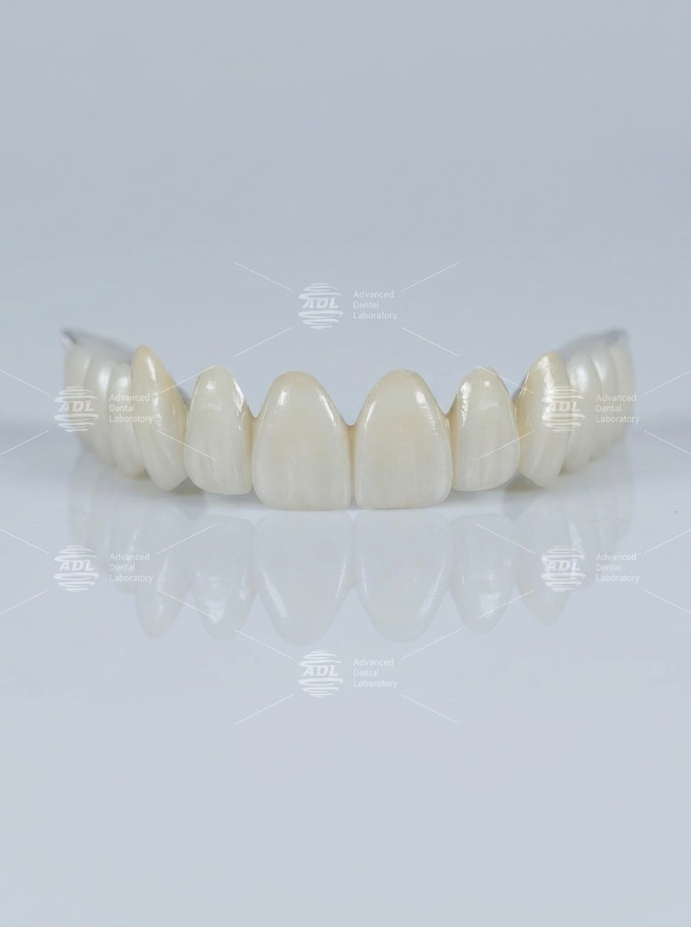 Dental Bridges